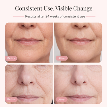 LumaSkin™ - LED Glow Mask